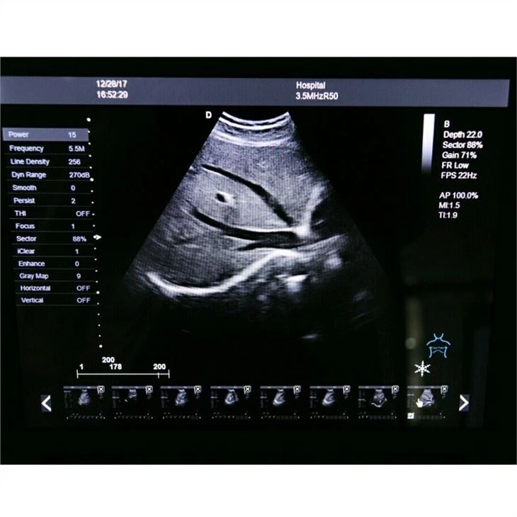 Laptop Color Ultrasound Machine